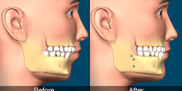 Orthognathic jaw surgery