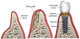 Bone grafting