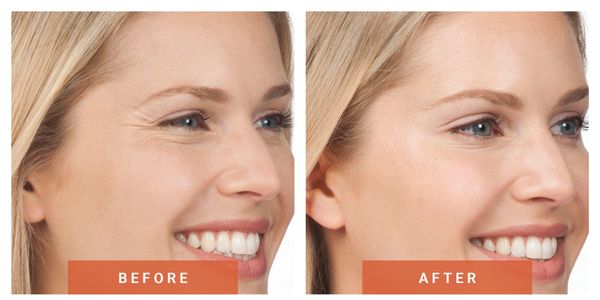 Botox cosmetic treatment