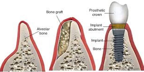 Dental implants