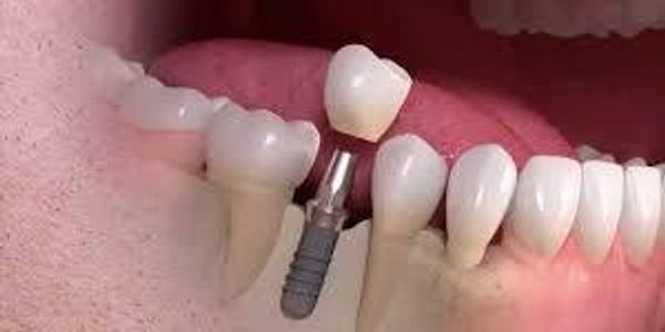 Impacted canines and surgical exposures